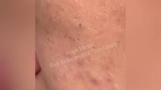 RodanFields Pore Tool For Blackhead Removal [upl. by Einotna]