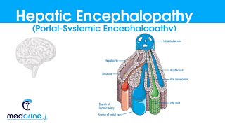 Hepatic Encephalopathy portal systemic encephalopathy causes classification featuresDX and rx [upl. by Bhayani354]