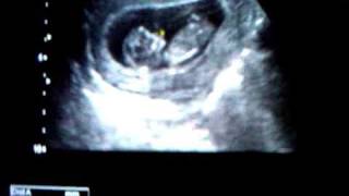 115 week ultrasound [upl. by Nomra]