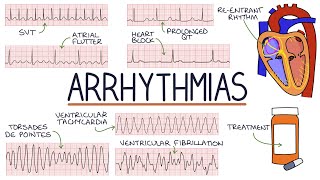 Understanding Arrhythmias [upl. by Lyrrad]