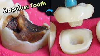 IMPOSSIBLE Restoration Of Tooth Caries  Amazing Before And After [upl. by Kila]