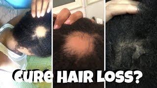 How to Cure Hair Loss [upl. by Breana]