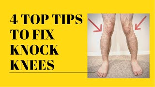 TOP TIPS TO FIX KNOCK KNEES WITHOUT SURGERY Physio Advice [upl. by Ajax]