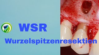 Die Wurzelspitzenresektion  WSR  retrograde Wurzelfüllung Schnittführung Zahnerhaltung [upl. by Eltsirhc]