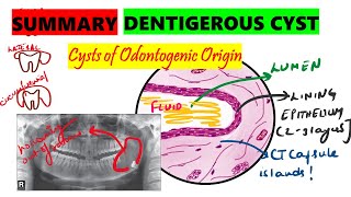 Dentigerous cyst  10 minute SUMMARY  Histopathology  Clinical features  Radiographic features [upl. by Avika]