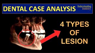 TRY TO DIAGNOSE A Case with 4 TYPES of PERIAPICAL LESIONS radicular cyst close to IAN Dental Quiz [upl. by Telford]