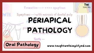 Periapical cyst  symptoms diagnosis differential diagnosis treatment theories of cyst formation [upl. by Aynotahs]