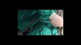 gynecomastia surgery in jaipur by Dr Anoop Sharma certified plastic surgeon [upl. by Eedak38]