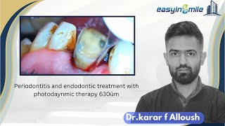 quotSingleVisit Restoration RCTand photodynamic therapy 630ūm quotTherapy for 7mm Deep Periodontitis [upl. by Selinski2]