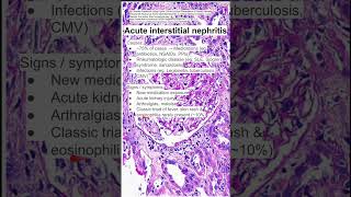 Acute interstitial nephritis [upl. by Jeth]