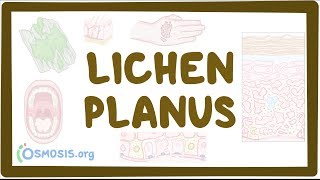 Lichen planus  causes symptoms diagnosis treatment pathology [upl. by Nolla]