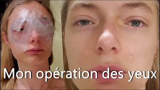 OPÉRATION HYPERMÉTROPIE FORTE ET ASTIGMATISME  Lasik [upl. by Fernyak]