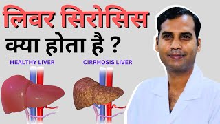 लिवर सिरोसिस क्या होता है  What is liver cirrhosis  Dr Sanjay Yadav  Liver Cirrhosis [upl. by Thornton842]