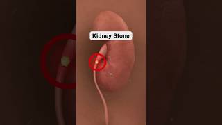 Leading Causes of Kidney Stones healthtips kidneystone shorts [upl. by Head]