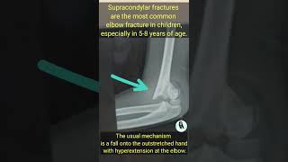 Supracondylar fracture of elbow  commonest fracture of children  gunstock deformity [upl. by Aset]