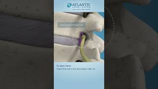 Lumbar Lateral Stenosis Shorts ​Atlantic Spine Center [upl. by Adalheid]