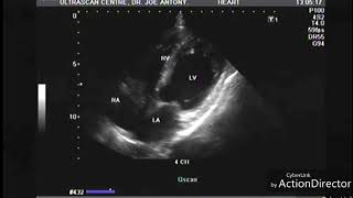 Myocardial infarction echocardiography [upl. by Valeria374]