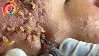 Ultimate Pimple Popping 2024 Satisfying Blackhead Extractions amp Acne Solutions [upl. by Drisko]