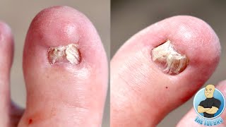 DAMAGED AND DEFORMED BIG TOENAILS AFTER FAILED NAIL SURGERIES REMOVING THEM FOREVER [upl. by Bronwen743]