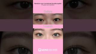 Droopy eyes correction ptosis shorts ptosis beforeandafter [upl. by Keffer]