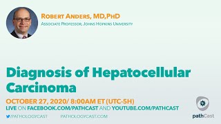 Diagnosis of hepatocellular carcinoma  Dr Anders Hopkins LIVERPATH [upl. by Huba973]