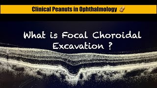 What is Focal Choroidal excavation  FCE [upl. by Ahsenrad240]