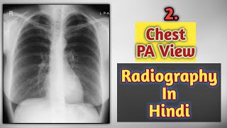 CHEST PA VIEW EXPLAINED IN HINDI  CHEST PA VIEW  CHEST RADIOGRAPHY [upl. by Moffit]