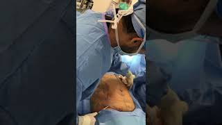 Liposuction Sculpting vs Fat Removal [upl. by Ikcin313]