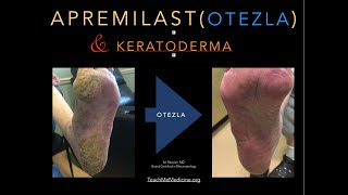 Apremilast Otezla and Keratoderma [upl. by Ailene]