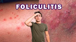 CÓMO ELIMINAR LA FOLICULITIS INFECCIOSA  BACTERIANA [upl. by Walther587]