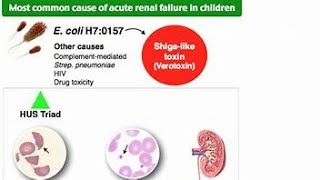 Hemolytic Uremic SyndromeHUS [upl. by Biamonte]