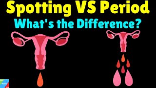 What is the difference between Spotting and Period – Spotting VS Period [upl. by Amadas]