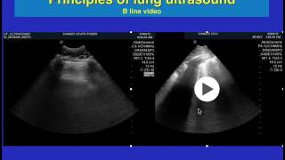 Pulmonary Edema [upl. by Neeruan502]