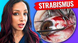 What Is Adjustable Suture Strabismus Surgery Eye Doctor Explains [upl. by Rehprotsirhc]