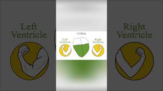 Congenitally corrected transposition of the great arteries CCTGA [upl. by Shore296]