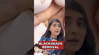 How to remove Blackheads from Nose  Blackhead removal  How to get rid of Blackheads [upl. by Beryle630]