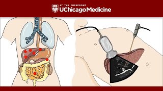 Understanding Neuroendocrine Tumors [upl. by Ojibbob]