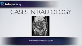 Cases in Radiology Episode 2 abdomen CT [upl. by Sutit]