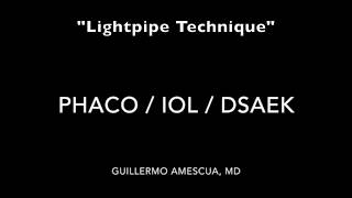 quotLightpipe Techniquequot Complex Phaco  IOL DSAEK [upl. by O'Shee13]