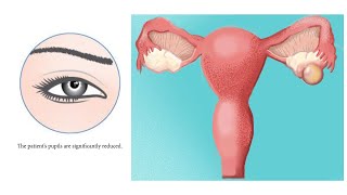 FACE READING FOR OVARIAN CYSTS [upl. by Bultman450]