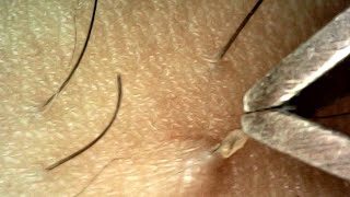 Pulling Hair and Blackheads with Tweezers [upl. by Aniuqal]