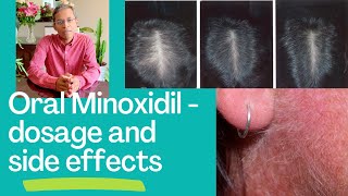 Oral Minoxidil for hair disorders  dosage and side effects [upl. by Det803]