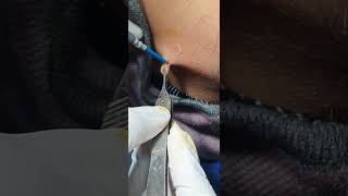 Skin tag removal cautery Laser જુઓ ચામડી નો મસો લેઝર કોટરી દ્વારા કેવી રીતે નીકળેDr Hitesh Patel [upl. by Zsa]