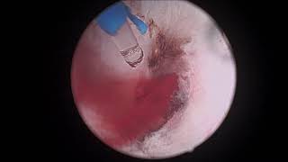 Holmium laser enucleation of the prostate HoLEP FULL SURGERY  142g [upl. by Aiseneg690]