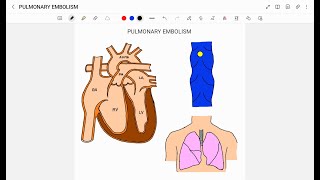 PULMONARY EMBOLISM [upl. by Llecrup573]