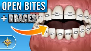 How Do Braces Fix Open Bites  Premier Orthodontics [upl. by Aldas]