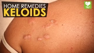 Keloids  Home Remedies  Health Tone Tips [upl. by Vincelette698]