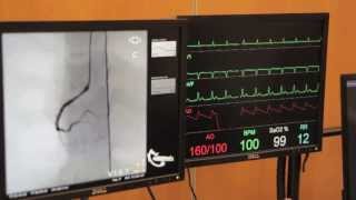 Cardiac Catheterisation Part 2  Right Coronary [upl. by Sweet251]