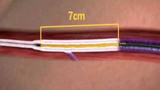 The VNUS Closure Procedure Using ClosureFAST Catheter [upl. by Ibloc]