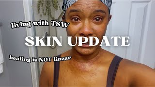 SKIN UPDATE  Eczema Journey amp Living w TSW [upl. by Chafee]